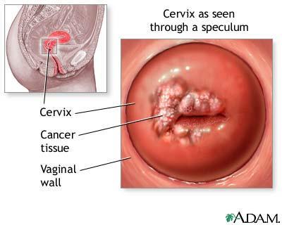 Signs and symptoms of cervical cancer Women with early cervical cancers and pre-cancers usually have no symptoms.
