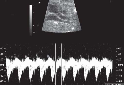 This can be performed by simultaneously measuring mitral inflow and aortic outflow (Figure 2).