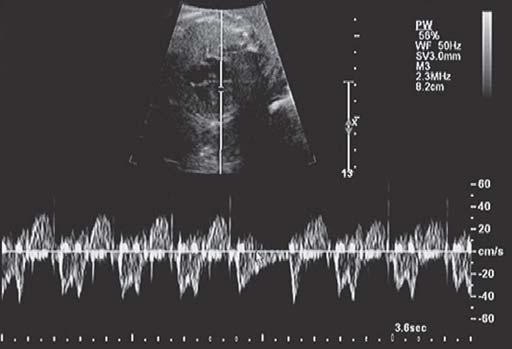 Evaluation of Fetal Arrhythmias Figure 5: Pulsed Doppler of a nonconducted premature atrial contraction Figure 6: Pulsed Doppler of a conducted premature atrial contraction PACs are the most common