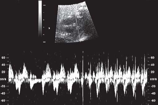 BRADYCARDIA A fetal bradycardia is defined as a persistent fetal heart-rate less than 100 bpm.