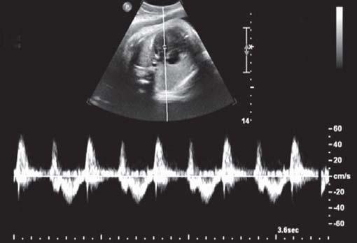 Evaluation of Fetal Arrhythmias Figure 9: Pulsed Doppler of blocked atrial bigeminy Figure 12: M-mode of complete heart block Figure 10: Pulsed Doppler of first degree heart block Figure 11: Pulsed