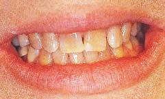 Figure 1 -The patient s pretreatment smile was very strained because she normally never smiled enough to reveal her teeth.