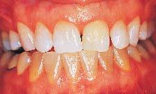 Figure 5 The tray was changed to a nonscalloped, noreservoir design at 7 months because of difficulty in lightening the gingival third.