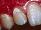 The Issue with Nomenclature enamel lesion non-cavitated diagnosis detection watch dentin lesion cavitated