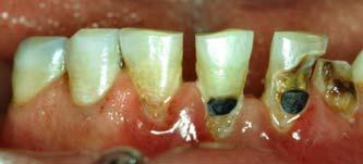 Dental Caries: is the process that occurs between the interaction of the tooth surface and subsurface with