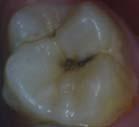 to a discontinuity in the surface) Dental caries is a disease, not a white spot nor a cavity.
