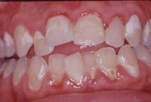 studies. Quick, cheap and easy. Should be performed on a dry, clean tooth, with good light, with a mirror. Useful on all surfaces and on all types of caries.