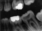 Hidden Caries or Mis-Diagnosis? When no lesion is detected by visual examination, but radiographic methods reveal a lesion into the dentin.
