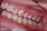 caries lesion activity in one appointment? Relate to appearance of lesion (chalky white, rough