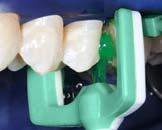 to prevent dental caries in at risk surfaces AND to arrest existing caries lesions.