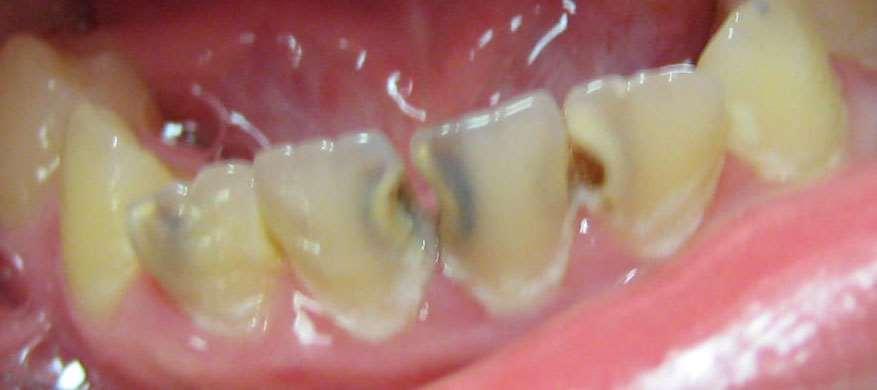 Caries of lower