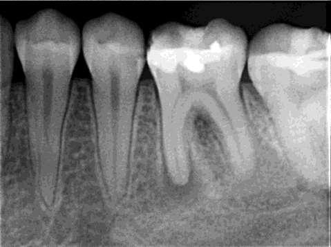 Permanent molars