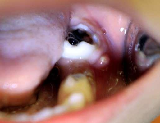 Permanent molars- Abscessus periapicalis