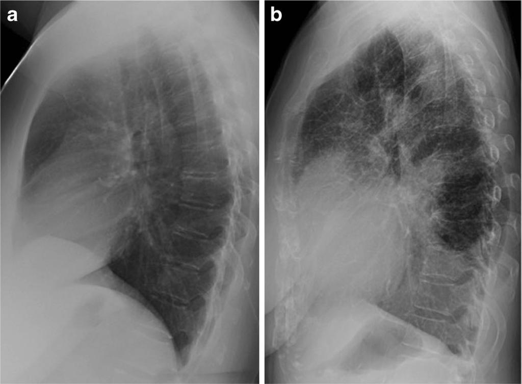 reticular opacities due to interstitial pulmonary oedema, known as BKerley D lines^ (b). Pleural effusions accompany the oedema Fig.
