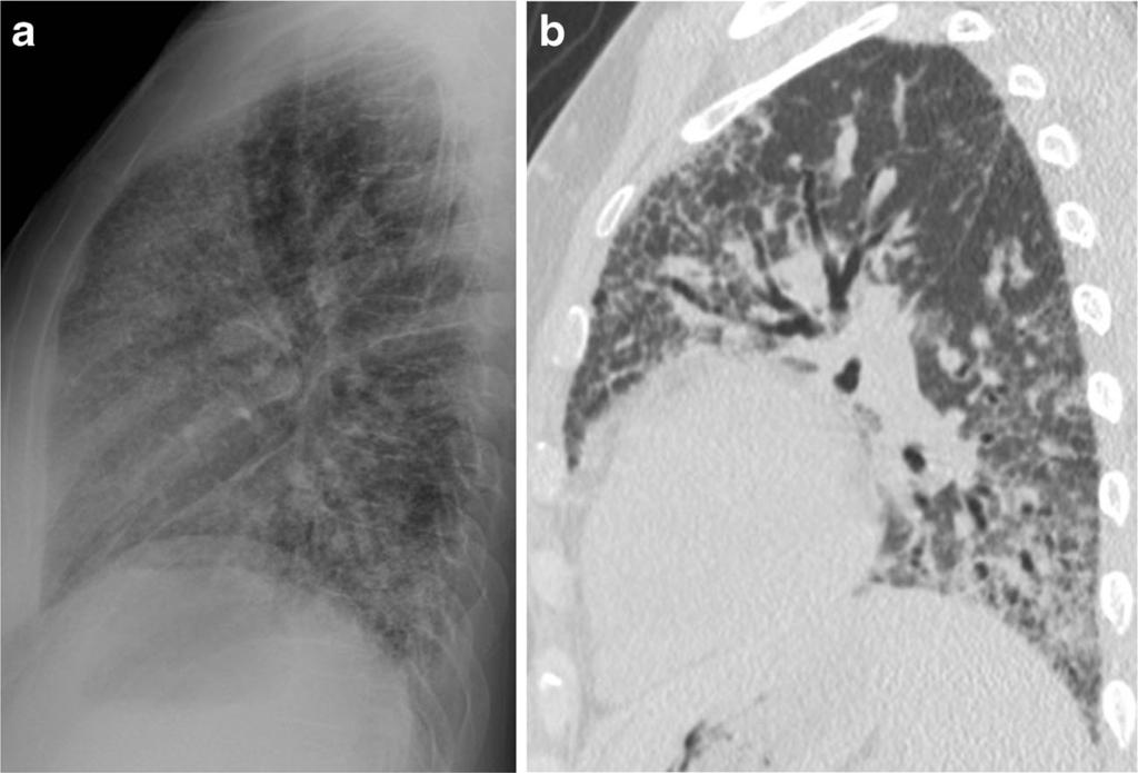 Insights Imaging (2017) 8:483 489 485 Fig. 3 53-year-old woman with chronic hypersensitivity pneumonitis.