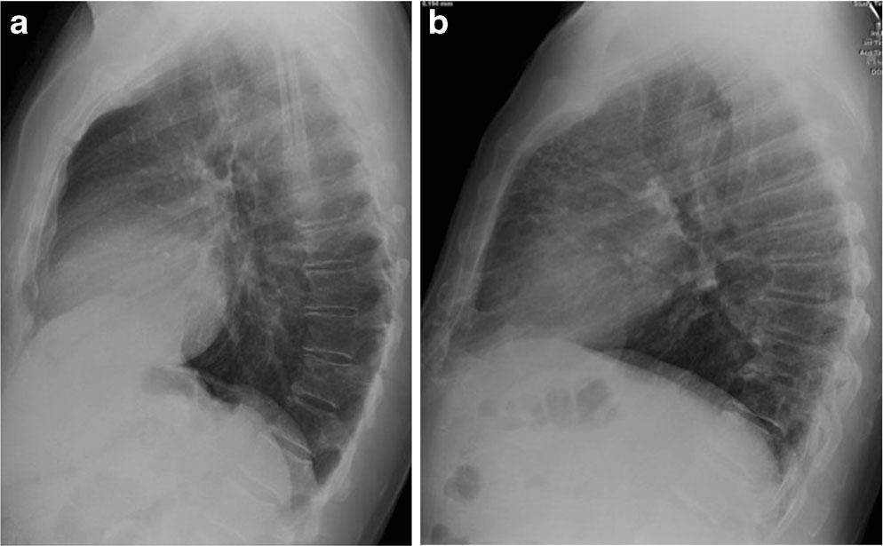 In contrast, coarse reticular opacities form a mesh and extend to the sternum (b) in a 67-year-old man with an unclassified pulmonary fibrosis (CT not shown) lateral view to be a useful supplement to