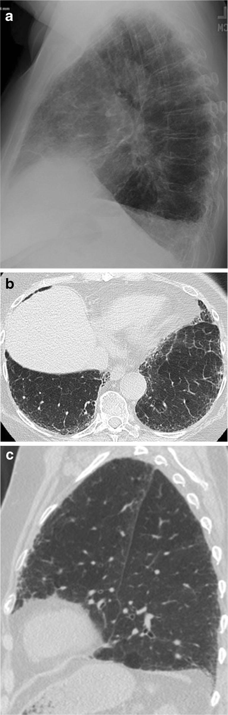 7 84-year-old woman with idiopathic pulmonary fibrosis. On the lateral radiograph (a), reticular opacities are easily seen through an opaque retrosternal space.