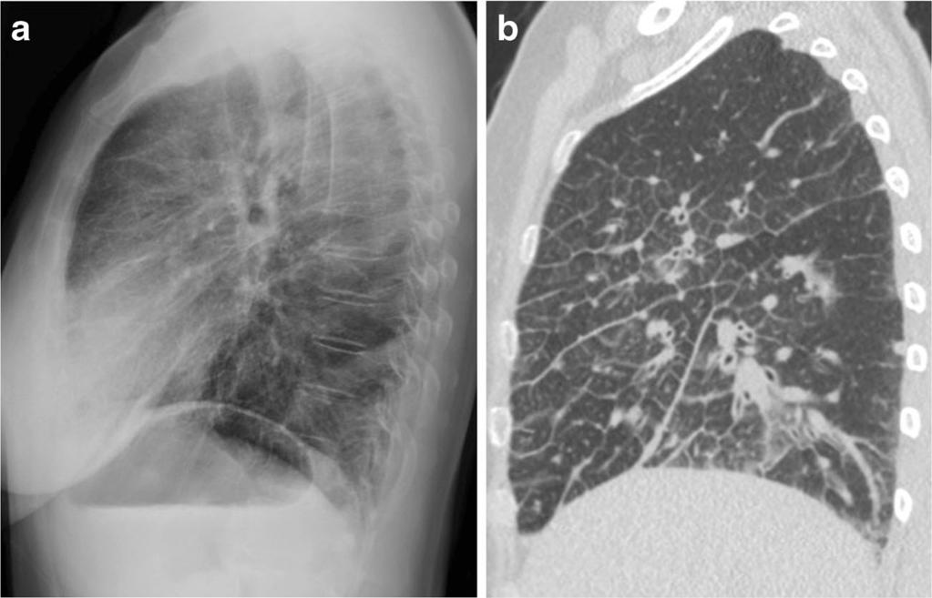 488 Insights Imaging (2017) 8:483 489 Fig. 8 62-year-old woman with metastatic lung adenocarcinoma and lymphangitic carcinomatosis.