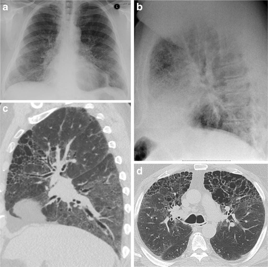 9 55-year-old man with smoking history. The frontal radiograph (a) is normal, and the lateral radiograph (b) shows reticular opacities in the retrosternal clear space only.