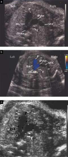 Fetal heart examinations were performed transabdominally or transvaginally as appropriate. The 3VT view The 3VT view was added to the classic or standard fetal echocardiography views.