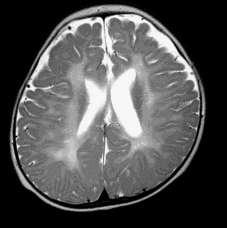 Leucodystrophy as a cause of neonatal encephalopathy Pelizaeus Merzbacher disease Classic (X-linked) onset weeks from