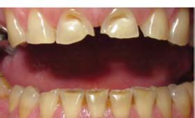 Dental erosion involves the demineralization and softening of the tooth surface, which once softened, is highly susceptible to abrasion and attrition (Figure 7).