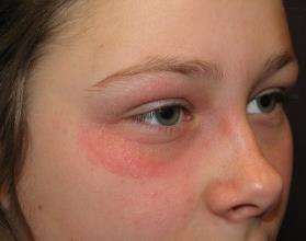 Contact dermatitis Acute, relapsing/intermittent or chronic presentation Irregular, variable, unilateral