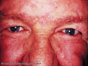 The face is not a common site for psoriasis. It occasionally presents with well demarcated plaques.
