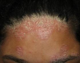 Facial psoriasis Eyelids, temples, retro- and preauricular skin and/or seborrhoeic dermatitis sites Also affects scalp, ears,