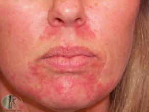A rash presenting around the mouth and chin. Small papules.