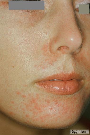 Perioral dermatitis Small papules around the mouth and sometimes nose and eyes.