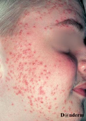 Steroid Acne Caused by the excessive use of oral or