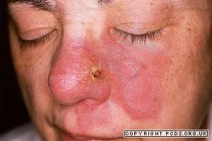 involvement Lupus Pernio : large bluish-red and dusky purple infiltrated
