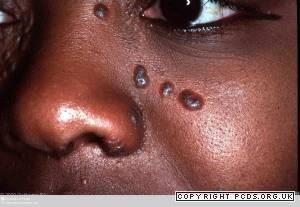 black women Red brown macules and papules