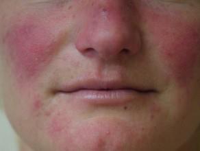 Rosacea Subtypes i)erythemovascular -erythema that is initially intermittent