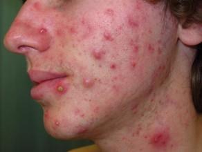 Acne Onset often at puberty 16-20yrs.
