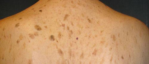 Seborrhoeic Keratosis Classical stuck on lesion Warty Brown Waxy/Rough Mul=ple Harmless but can