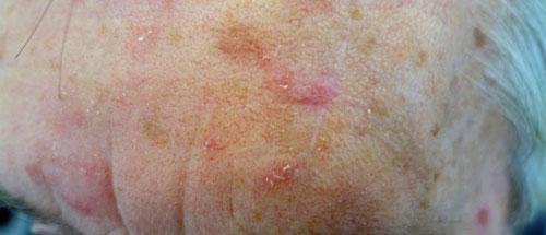 Ac=nic Keratoses Thickened, rough areas Corn flakes stuck on the skin Can come and