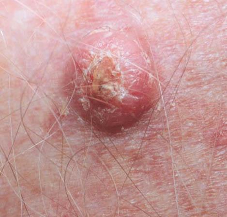 Squamous Cell Carcinoma Associated with chronic sun exposure Increased if immune system is suppressed Present as dome like lesion with central scaly