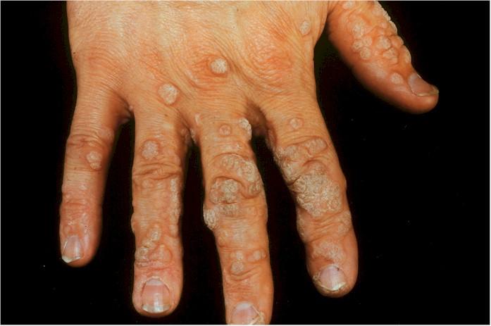 Warts Viral warts triggered by HPV Very resistant to treatment