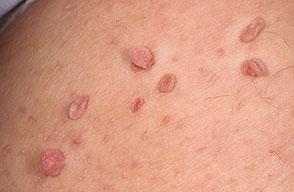 Moles & Skin Tags Mul=ple skin tags can be associated with pre- diabetes Skin