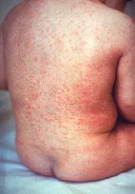 The article also outlined advice regarding pregnant women who come in contact with these diseases. A rash is any change of the skin which affects its colour, appearance or texture.