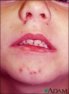 Impetigo Impetigo is a highly contagious disease caused by streptococcus or staphylococcus bacteria. It causes a superficial skin infection which appears red with yellow or golden crusts.