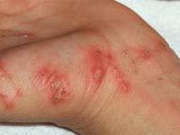 Scabies Scabies is an itchy rash caused by a little mite that burrows in the skin surface.