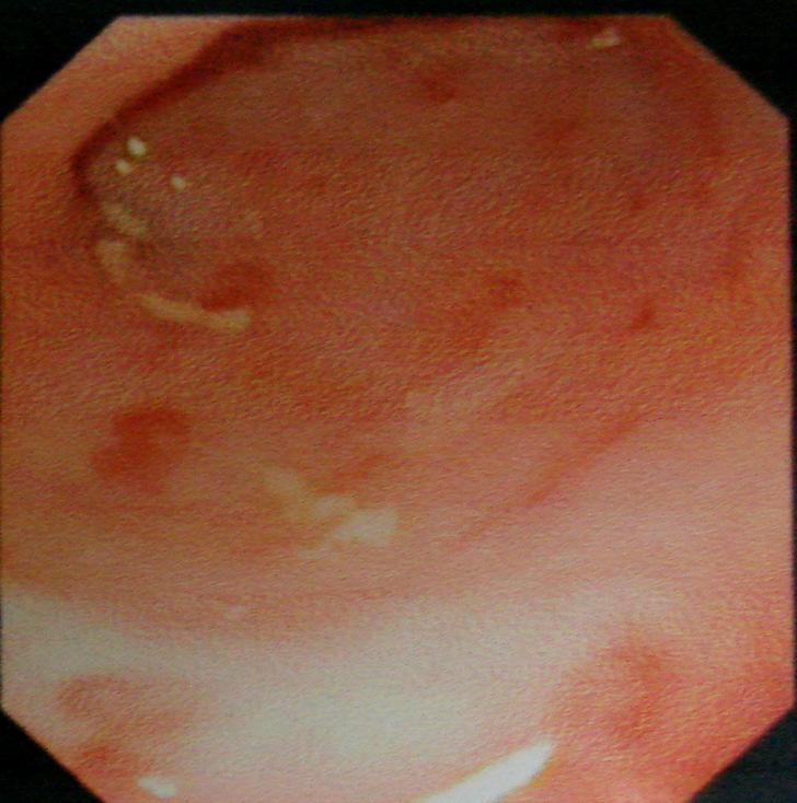 On colonoscopy there is patchy regional erythema and haemorrhoagic erosions and microscopic eosinophilic and plasma cell infilteration of lamina propria (possibly with edema) which distinguish this