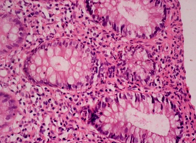 >or= 6 eosinophils per high power field and/or eosinophils in colonic crypts or mucularis mucosa. (2) Histopathological findings were; lymphoid aggregates in 94.
