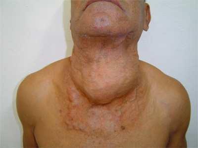 carcinoma of thyroid Papillary carcinoma Follicular carcinoma Medullary carcinoma Anaplastic carcinoma Thyroid