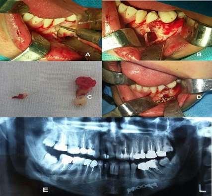Surgical management of Ossifying Fibroma of the mandible Figure 4: A.