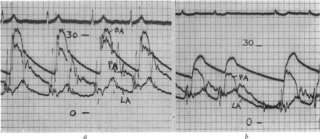 498 S. A. Forsberg I-.le.!.:::::..~~~~~~~~~~~~~~~~~~~~~~~~~~~~...... At...A FIG. 5 Records from ptients with mitrl stenosis nd tril fibrilltion.