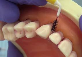 Hortzarteko- eskuilatxoa Abantailak Tratamendu periodontal ez kirurgikoa Erabilera erraza.